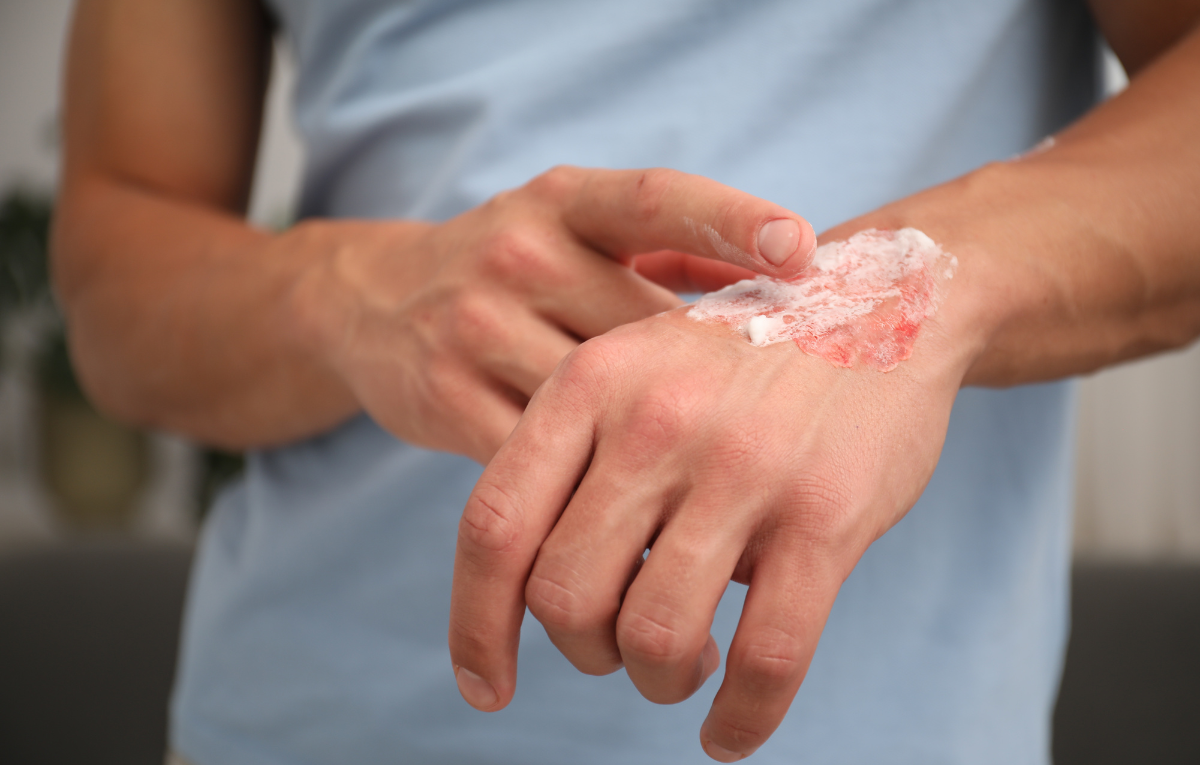 queimei-com-oleo-quente-e-deu-bolha-o-que-fazer-para-tirar-a-dor-rapido